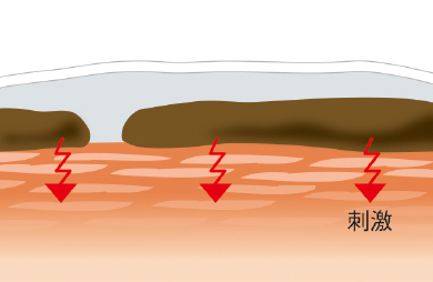 皮膚に付着した便が与える刺激のイメージ画像です