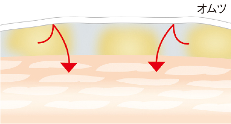 オムツ内がムレたとき、 皮膚が浸軟する様子を表したイメージ画像です