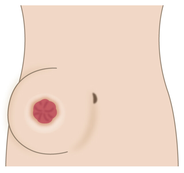 傍ストーマヘルニアのイメージ