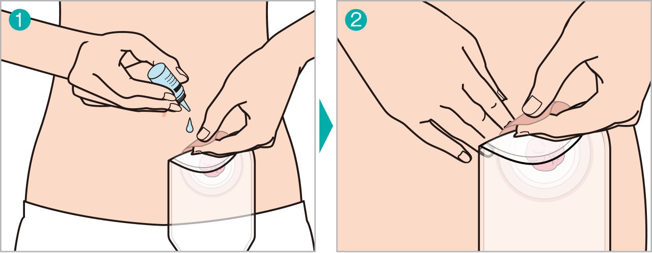 左：剥離剤を使ってストーマ送付を剥がしている様子、右：皮膚と面板の間に指を入れて、皮膚を押えながらストーマ装具を剥がしている様子